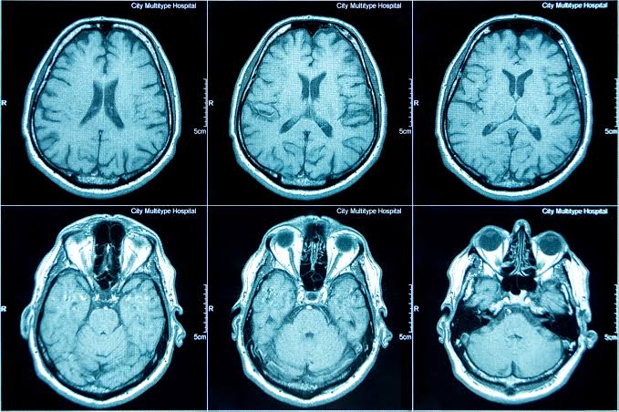 CT Scans