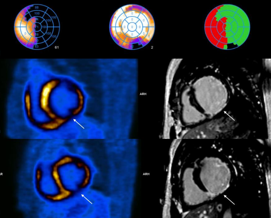 Regional Cardiac FDG PET CT