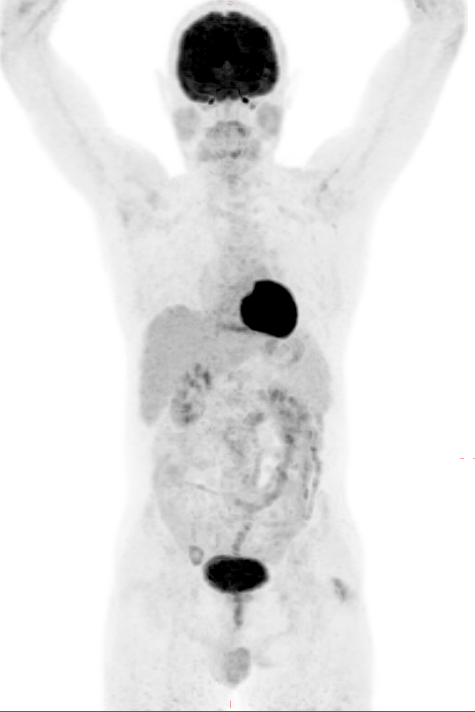Wholebody FDG PET CT