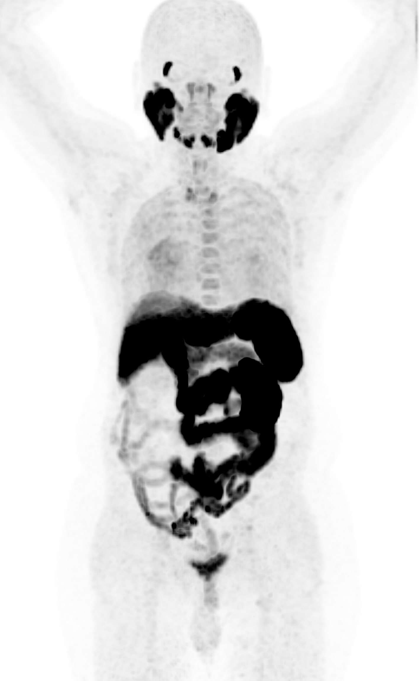 Wholebody PSMA PET CT